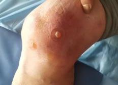 如何无痛发泡，加止痒方法