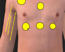 乳腺增生乳腺问题的拔罐方法