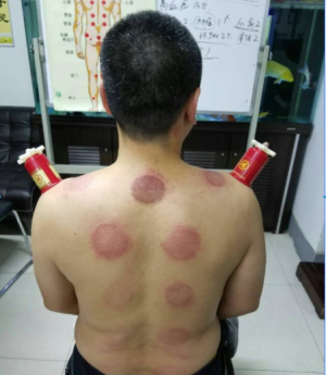 萨满48穴取穴点。萨满罐取穴方法参考。